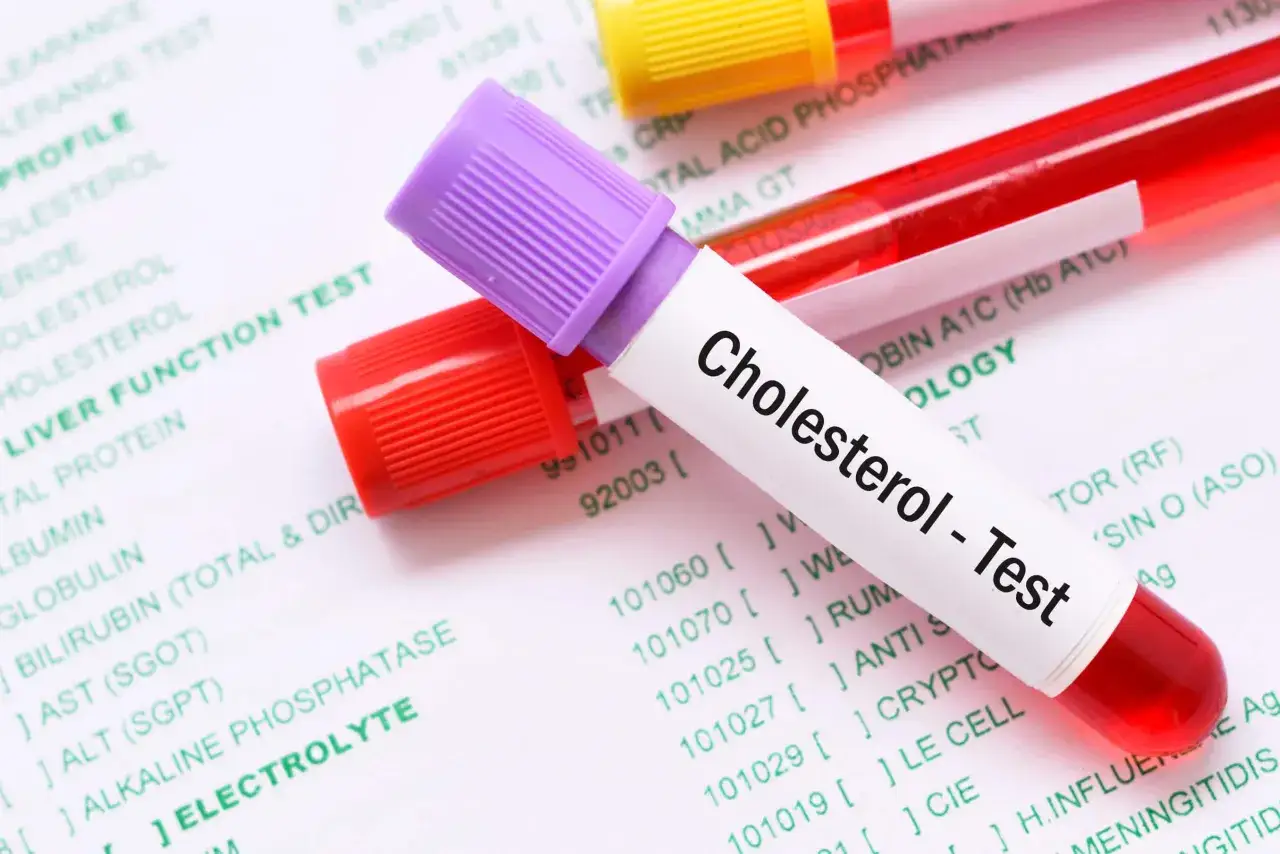 Zdjęcie Jak odczytać wyniki cholesterolu i uniknąć poważnych problemów zdrowotnych